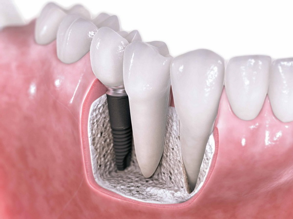 Безопасна ли имплантация зубов?